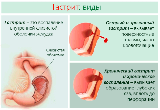 Gastritis