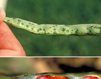 Bean Disease